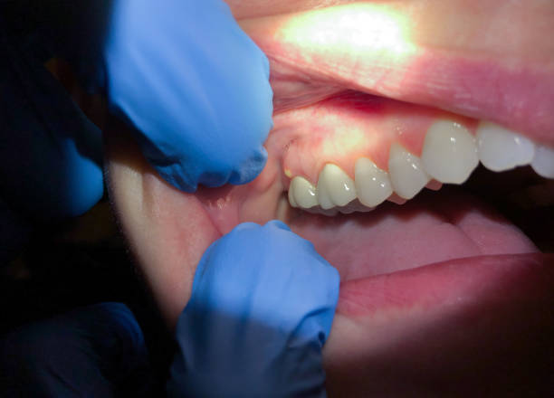 Best Dentist for Tooth Abscess  in Bowling Green, MO